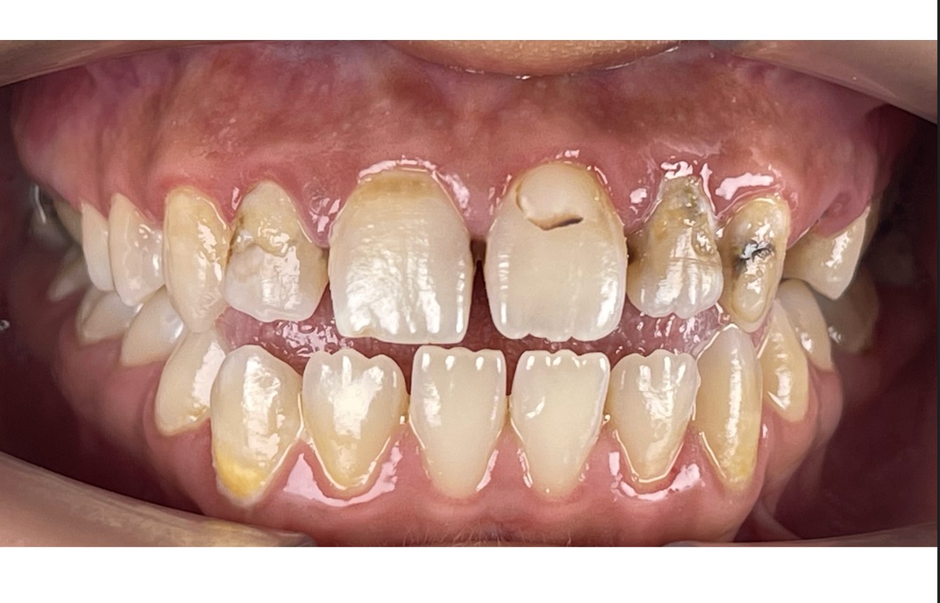 Avant alignement orthodontique